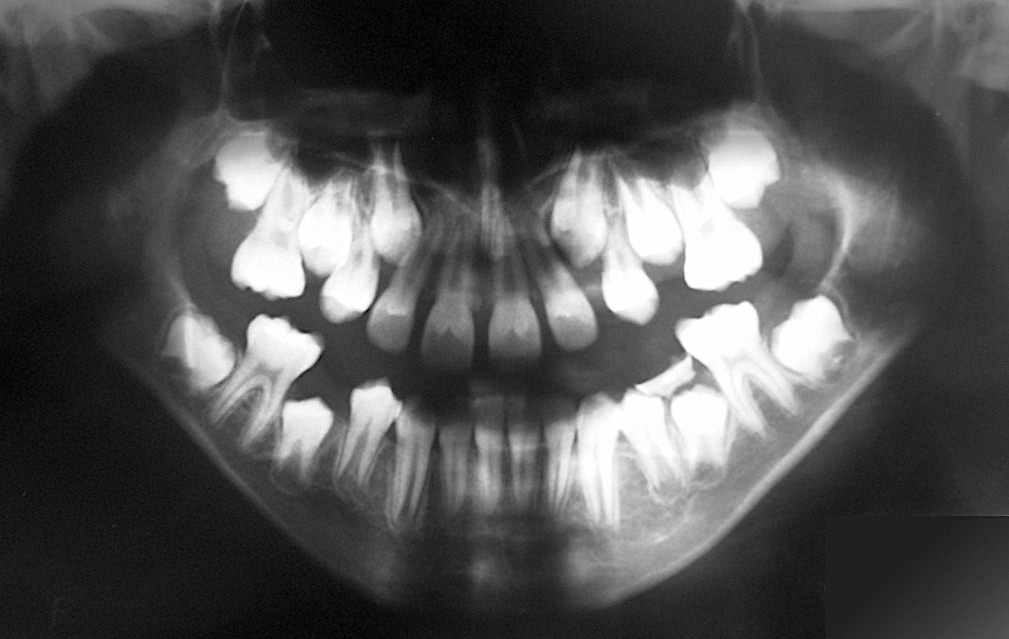 figure 3 initial panoramic radiograph