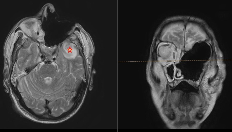 Desh Pattern figure 5 mri brain of case 2 after debridement the star indicates the ...