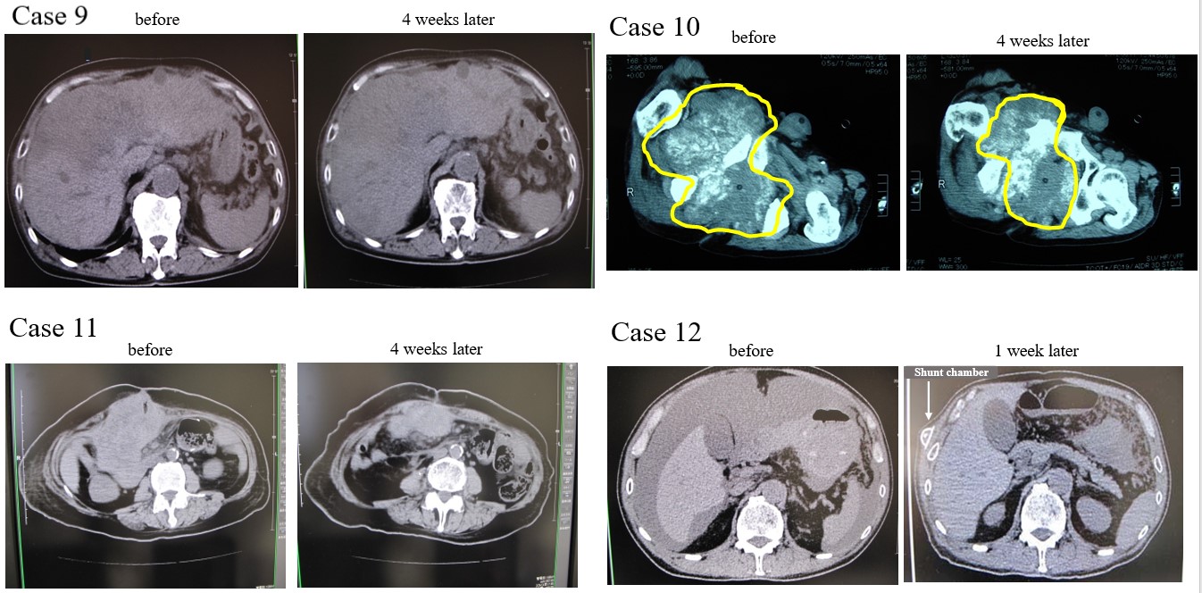 figure 4 ct images showing the clinical course for case 9 to case 12 in ...