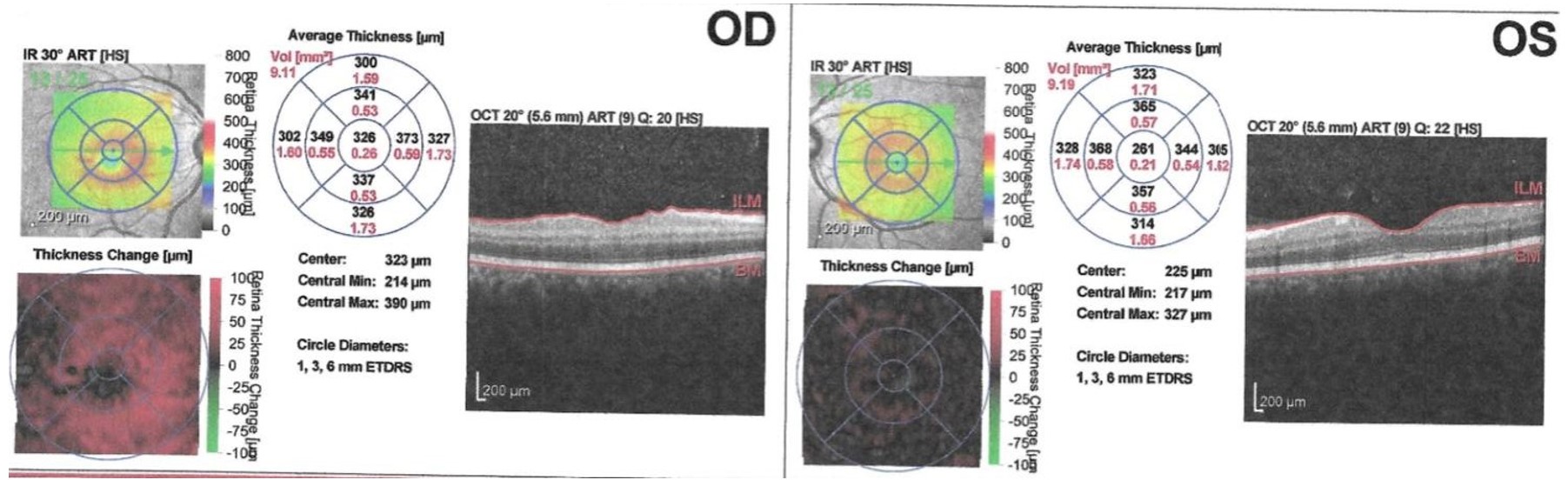 figure 1 retinal optical coherence tomography oct showing crao on od ...