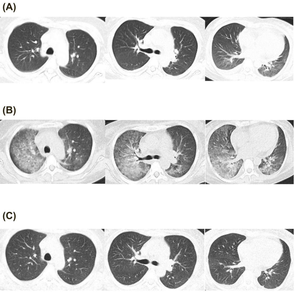 figure 1 chest ct images a ct at admission b diffused glass ground ...
