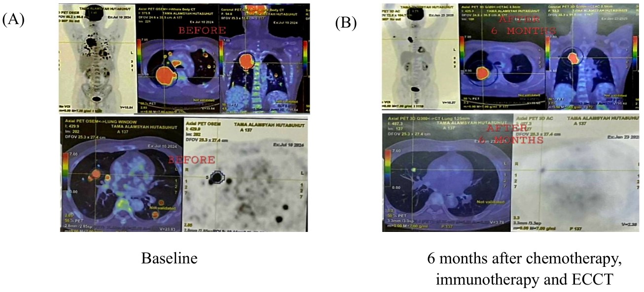 figure 2 case 2 baseline pet ct a and 6