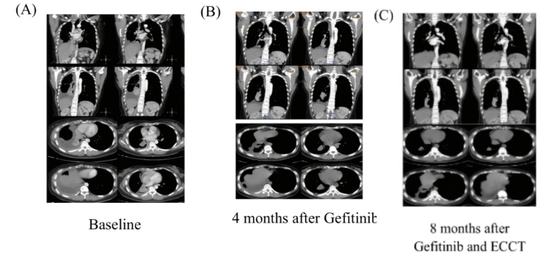 figure 3 case 3 baseline ct a 4 month b