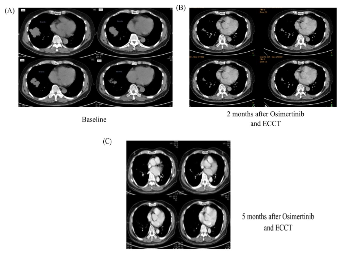 figure 4 case 4 baseline ct a 2 month b