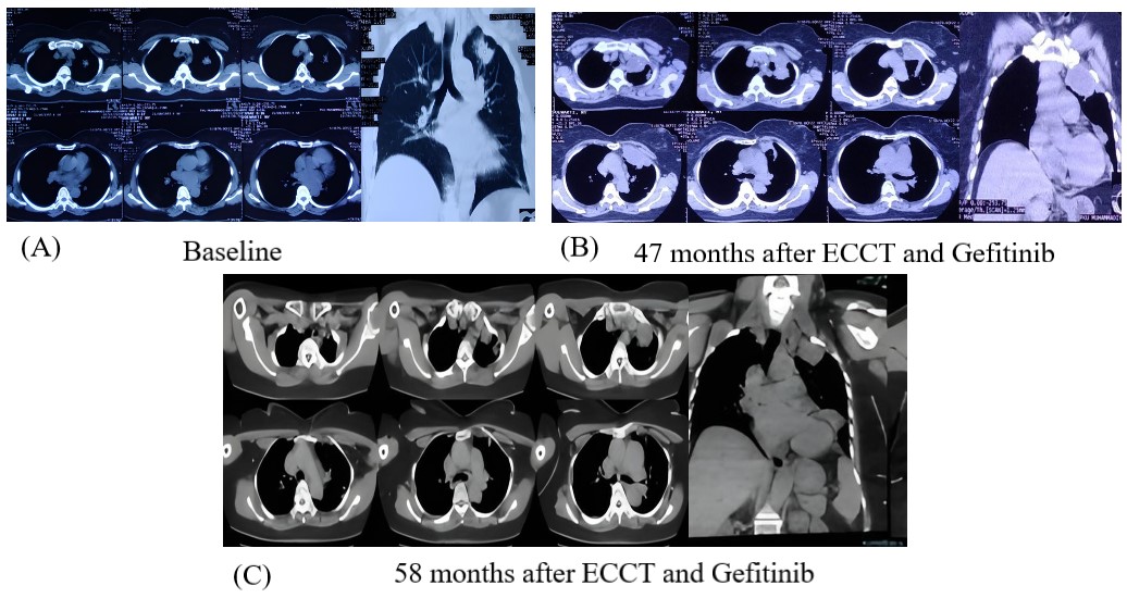 figure 6 case 6 baseline ct a 47 month b and 58 month c scans showing ...